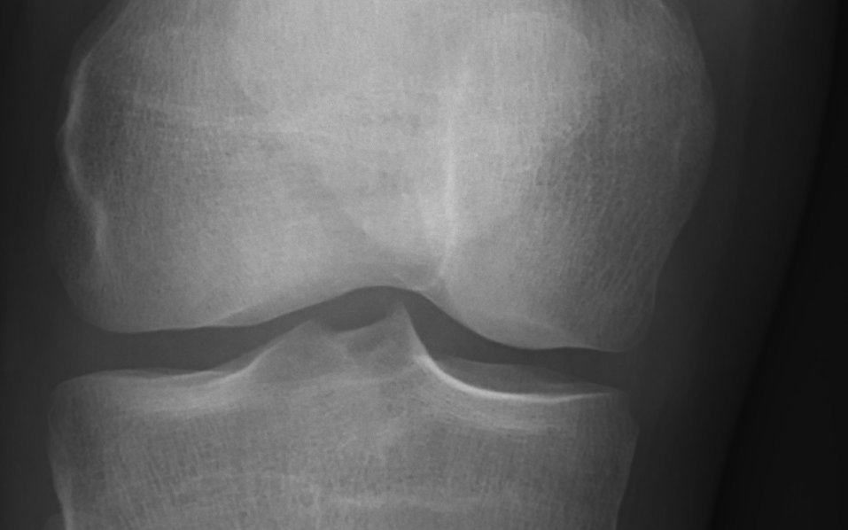 Radiografia de um joelho visto de frente, com o fêmur em cima e a tíbia embaixo.